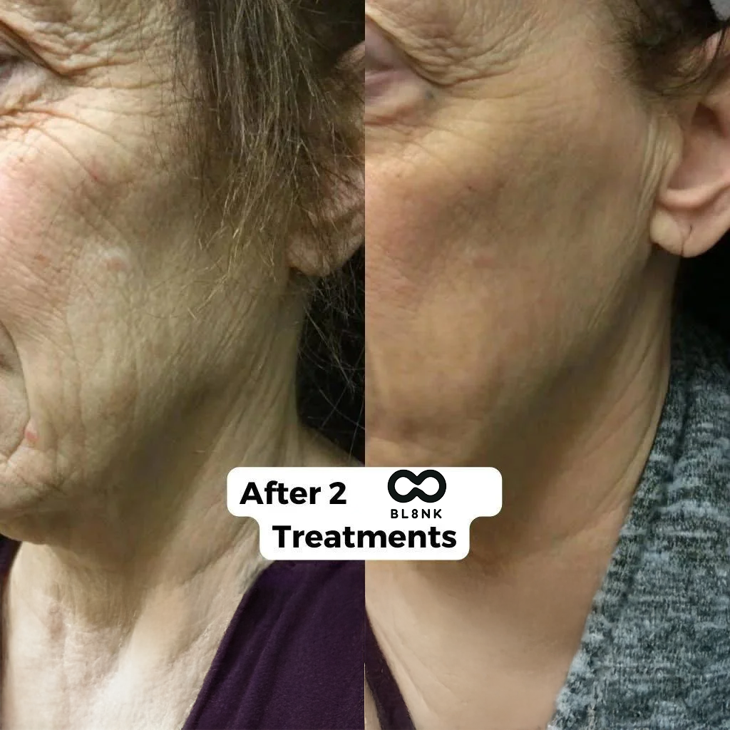 The Senofusion™ System (2 per/ Month)