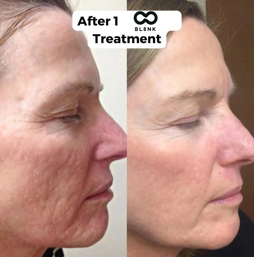 The Senofusion™ System (2 per/ Month)