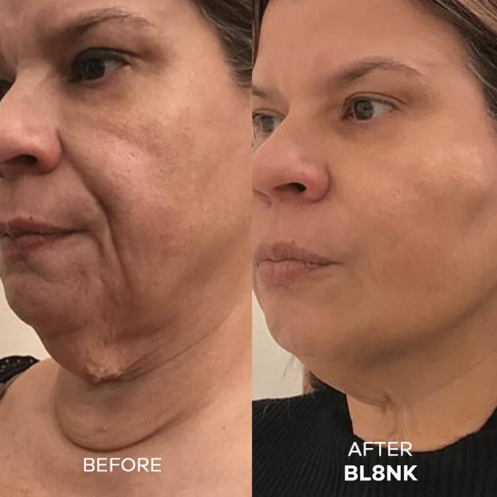 The Senofusion™ System (2 per/ Month)